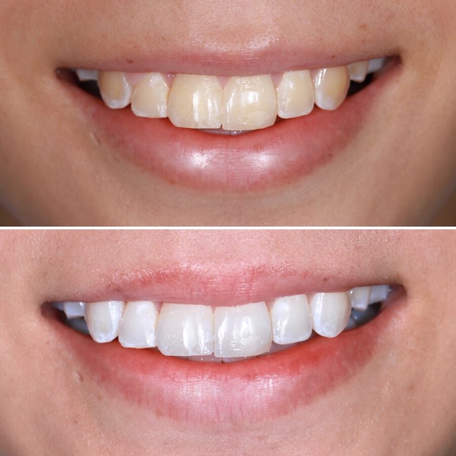 Aclaramiento dental
