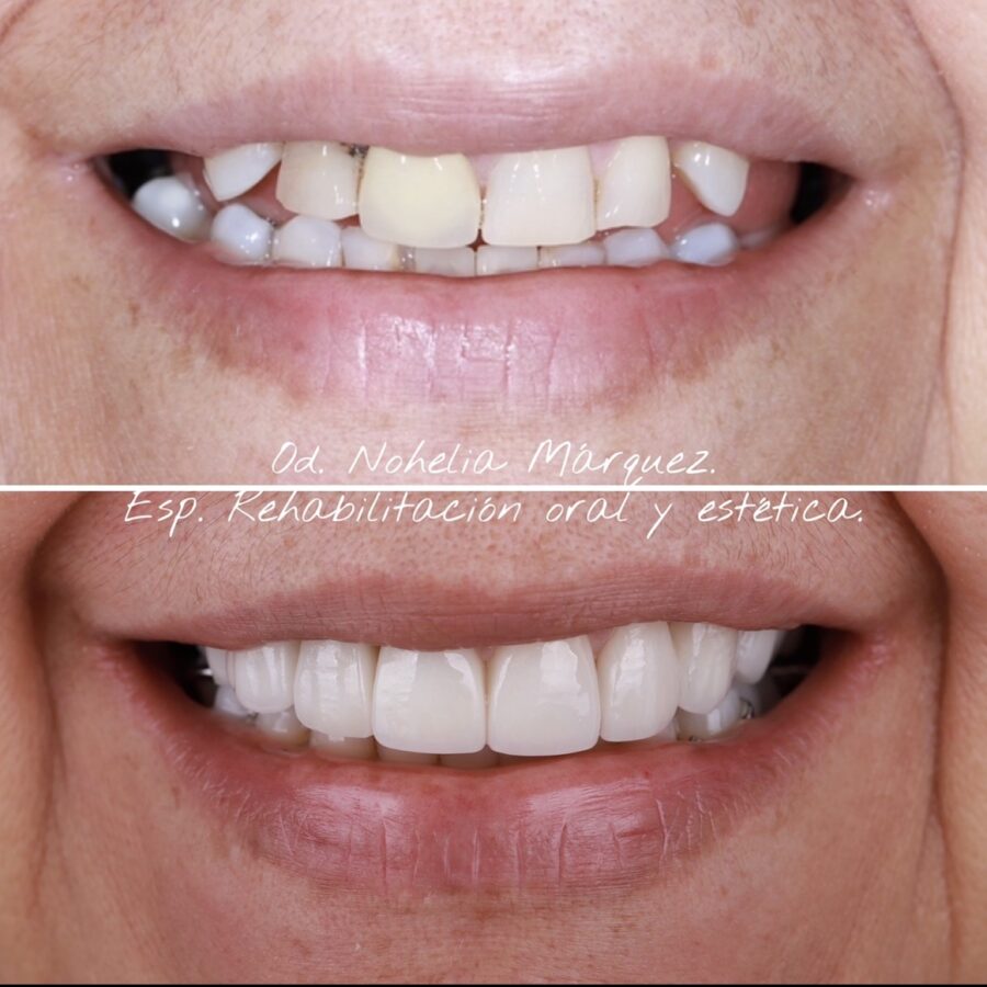 Rehabilitación oral